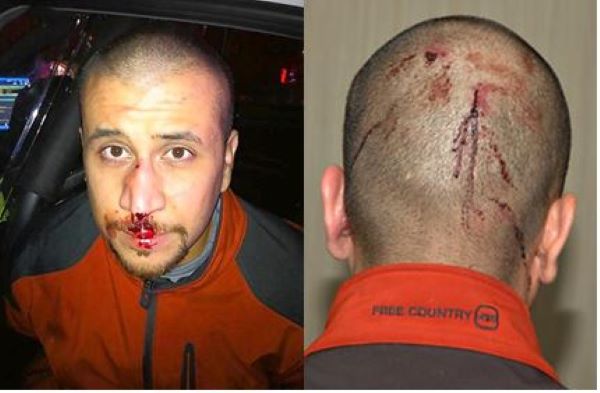 Photos of George Zimmerman�s Injuries 